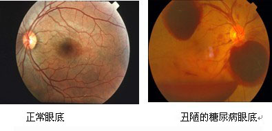 患发眼底出血的饮食要点有哪些呢
